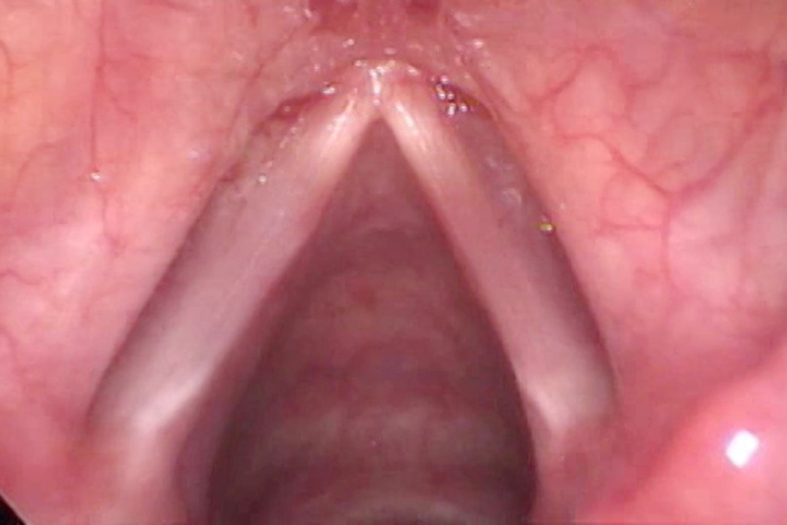 Nodules On The Throat 55