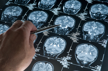 Concussion research