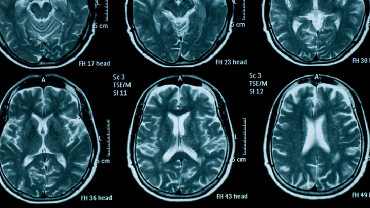 Parkinson's disease research paper