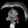 Coronary Calcium Scoring Coronary Calcium Scoring