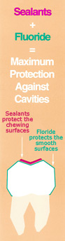 Sealants + Fluoride = Maximum Protection Against Cavitites Sealants + Fluoride = Maximum Protection Against Cavitites