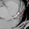 Cardiac CTA Cardiac CTA