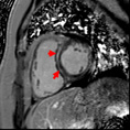 Cardiac MRI Cardiac MRI