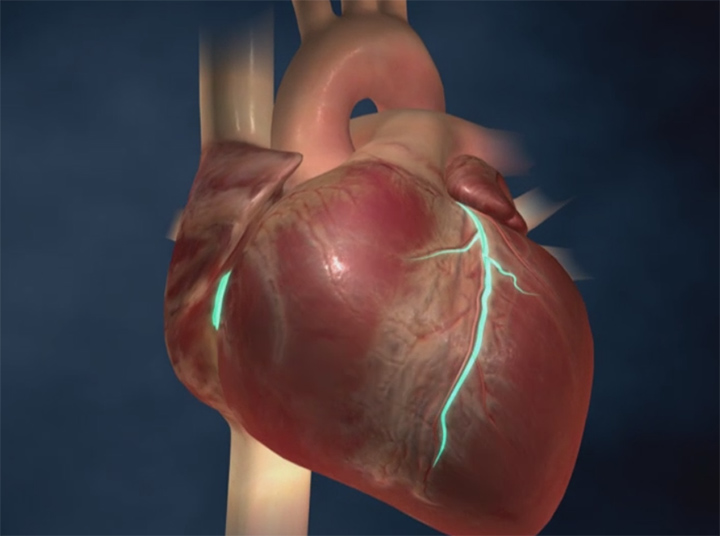 Coronary Artery Disease Signs, Diagnosis & Treatment NorthShore
