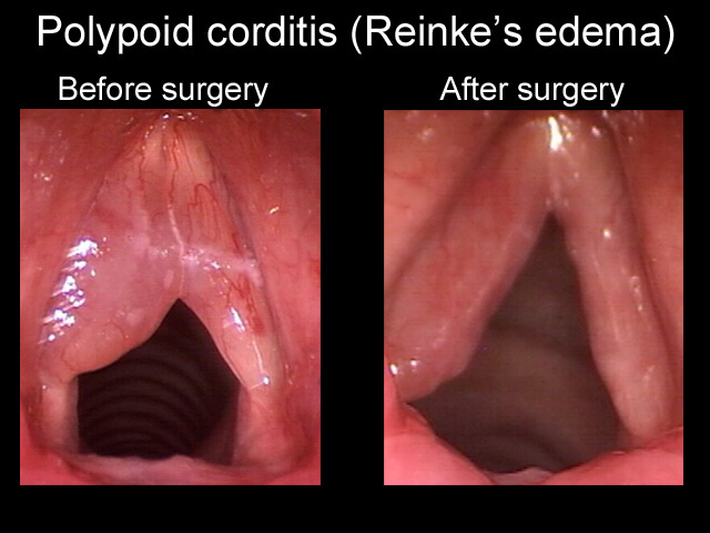 Polypoid Corditis - Before and After 