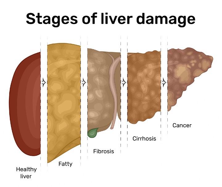 Illustration of the progression of liver disease from fatty liver to cancer