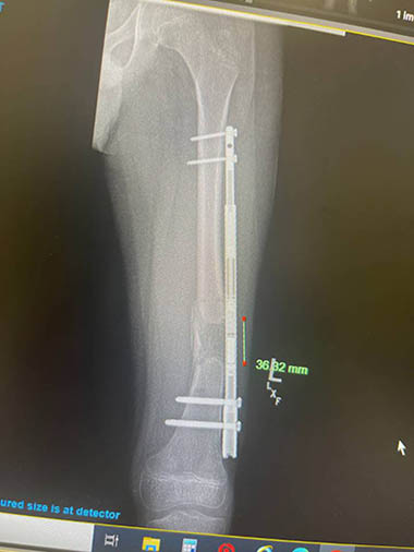 x-ray of leg