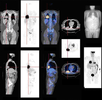 Full PET Scan