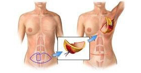Diagram of a DIEP breast reconstruction