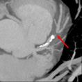 Cardiac CTA