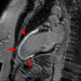 Cardiac MRI