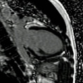 Cardiac MRI