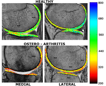 Osteoarthritis